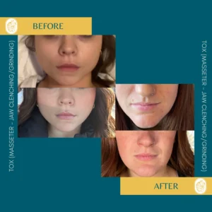 Botox Results & Transformations