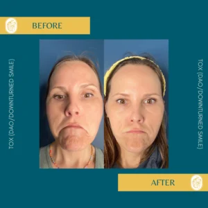 Botox Results & Transformations