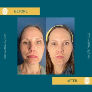 Botox Results & Transformations