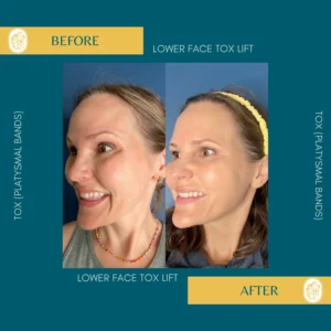 Botox Results & Transformations