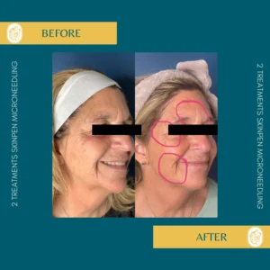 Skinpen Microneedling