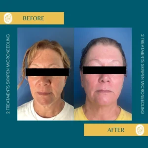 Skinpen Microneedling