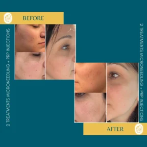 Skinpen Microneedling
