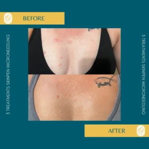 Skinpen Microneedling