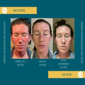 Skinpen Microneedling