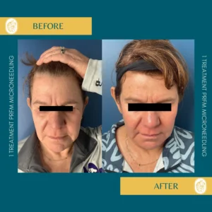 Skinpen Microneedling