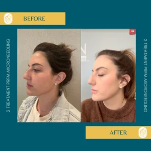 Skinpen Microneedling