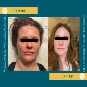 Microchanneling Booster Bar