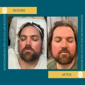 Microchanneling Booster Bar