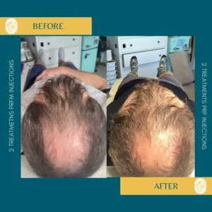 Hair Restoration