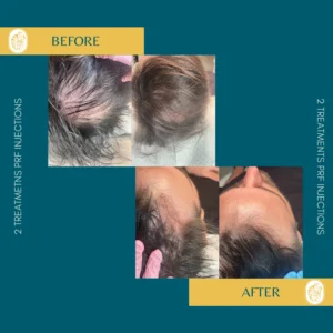 Hair Restoration