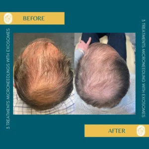 Hair Restoration