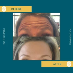 Botox Results & Transformations