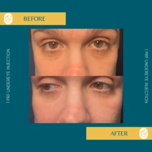 PRP/PRF/PDGF Facial Rejuvenation