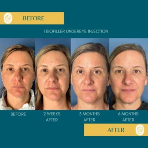 PRP/PRF/PDGF Facial Rejuvenation