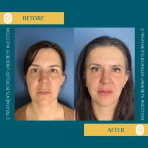 PRP/PRF/PDGF Facial Rejuvenation
