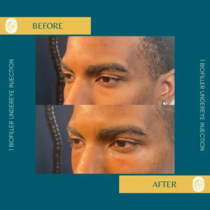 PRP/PRF/PDGF Facial Rejuvenation