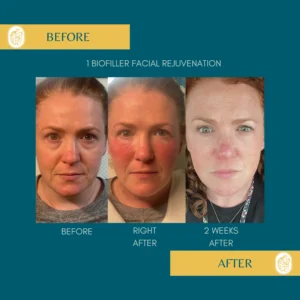 PRP/PRF/PDGF Facial Rejuvenation