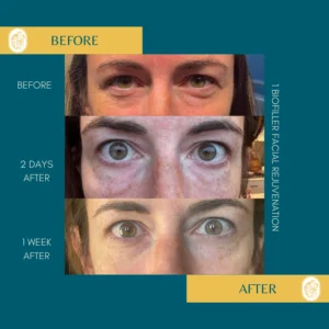 PRP/PRF/PDGF Facial Rejuvenation