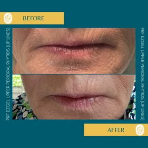 PRP/PRF/PDGF Facial Rejuvenation