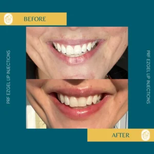 PRP/PRF/PDGF Facial Rejuvenation