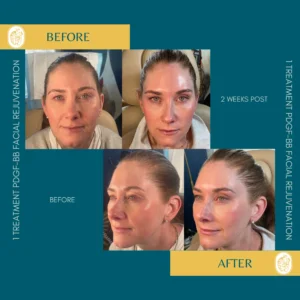 PRP/PRF/PDGF Facial Rejuvenation