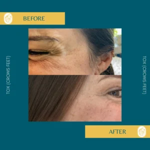 Botox Results & Transformations
