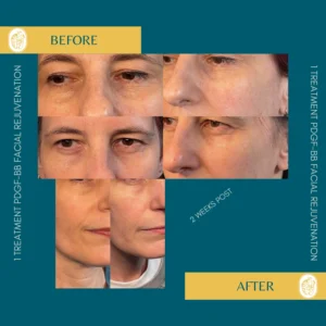 PRP/PRF/PDGF Facial Rejuvenation