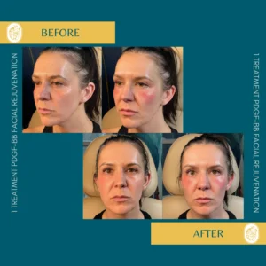 PRP/PRF/PDGF Facial Rejuvenation