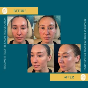 PRP/PRF/PDGF Facial Rejuvenation