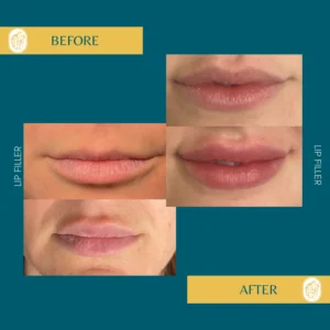 Lip Filler