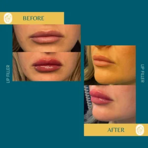 Lip Filler