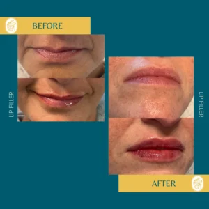 Lip Filler
