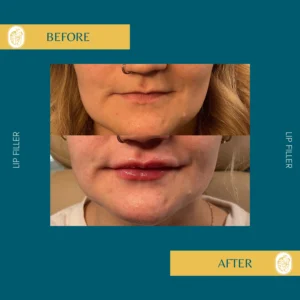 Lip Filler