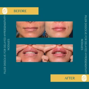 Lip Filler