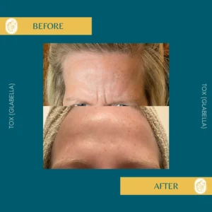 Botox Results & Transformations