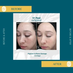 Chemical Peels
