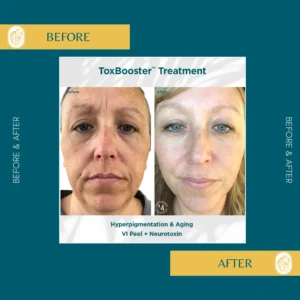 Chemical Peels