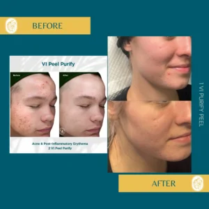 Chemical Peels