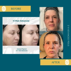 Chemical Peels