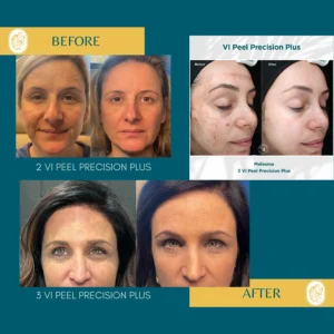Chemical Peels