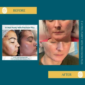 Chemical Peels