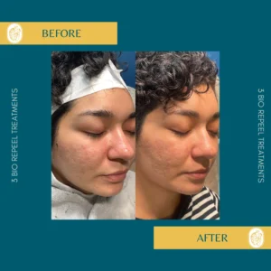 Chemical Peels