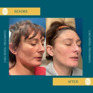 Chemical Peels