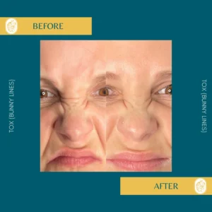 Botox Results & Transformations