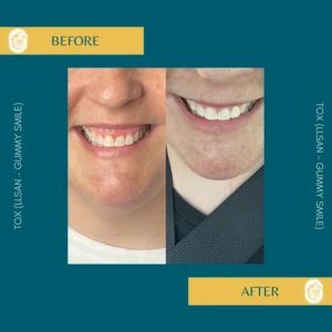 Botox Results & Transformations