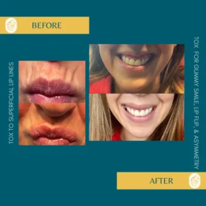 Botox Results & Transformations