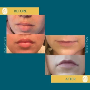 Botox Results & Transformations