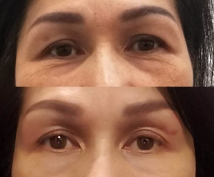 Banish Blemishes - reclaim your skin with Plasmage!