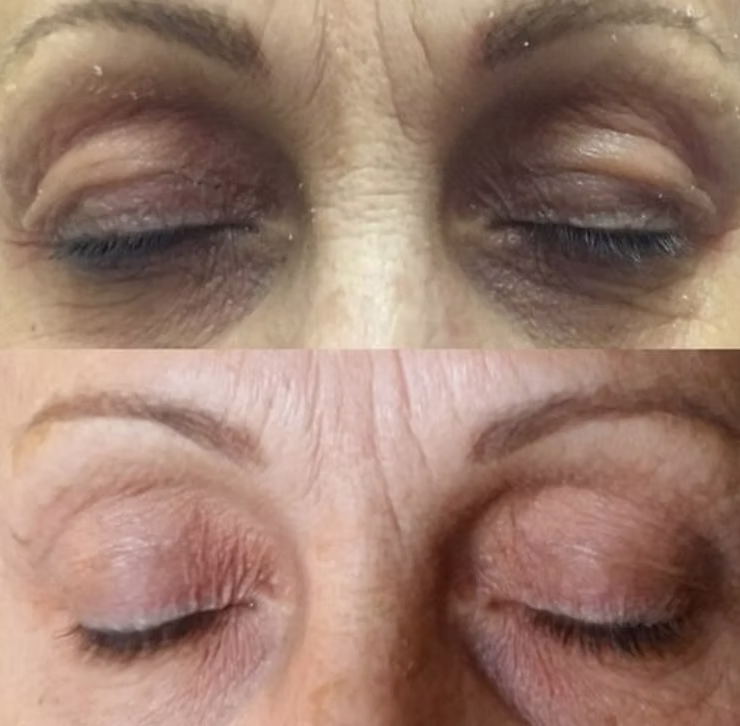 Banish Blemishes - reclaim your skin with Plasmage!